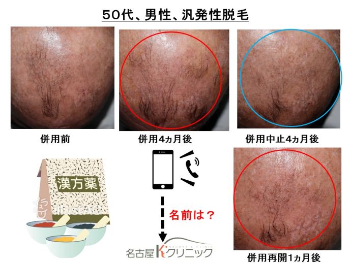 円形脱毛症　病院